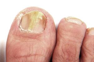 img-onicomicosis